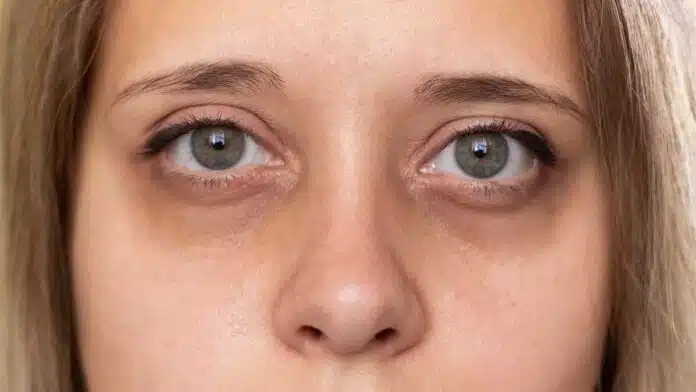 Remove Dark Circles under eyes! Get beautiful and glowing skin