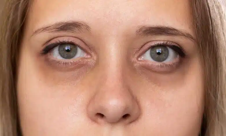 Remove Dark Circles under eyes! Get beautiful and glowing skin