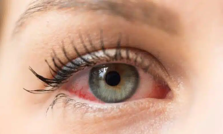 Should Dry Eyes be washed frequently or not