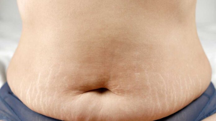 These home remedies will reduce the problem of stretch marks