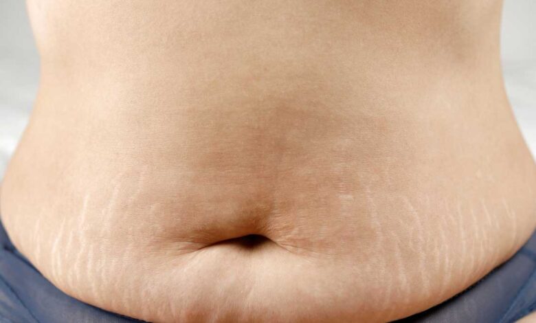 These home remedies will reduce the problem of stretch marks