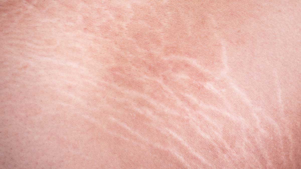 These home remedies will reduce the problem of stretch marks