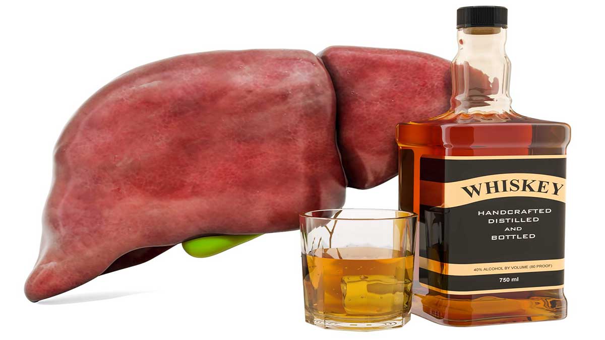 Information and treatment of Alcoholic Liver Disease