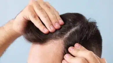 7 common causes of dandruff that you must know