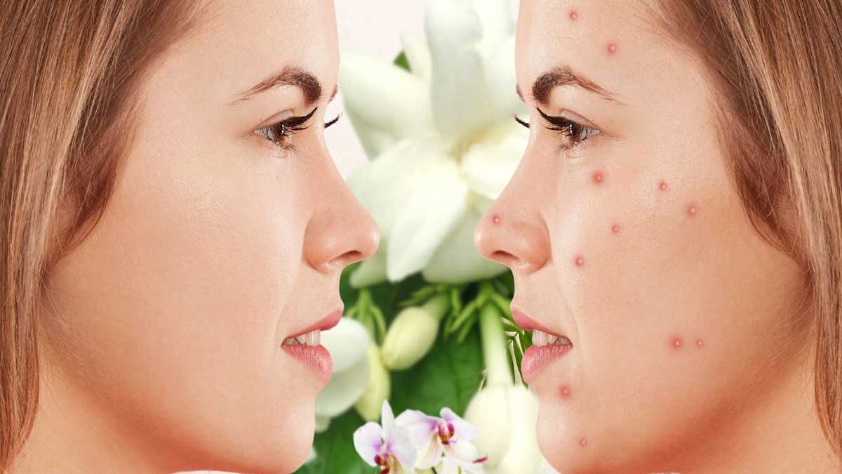 Acne Causes, Types, Treatment and Prevention