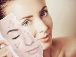 Acne Causes, Types, Treatment and Prevention