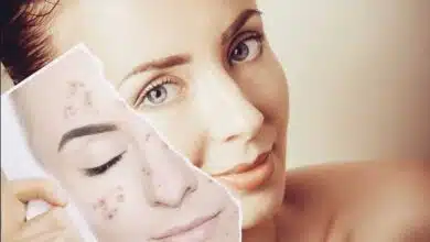 Acne Causes, Types, Treatment and Prevention