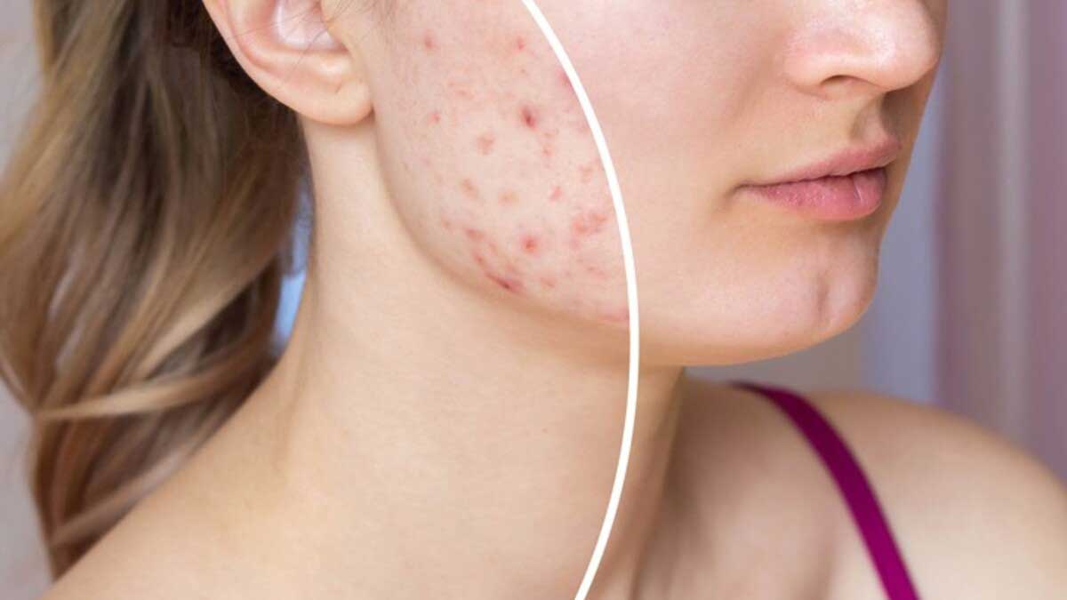 Acne Causes, Types, Treatment and Prevention