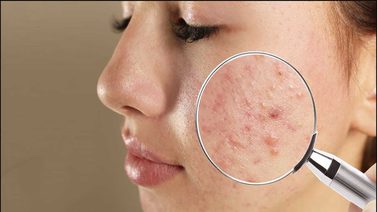 Acne Causes, Types, Treatment and Prevention