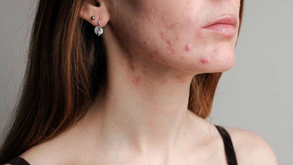 Acne Causes, Types, Treatment and Prevention