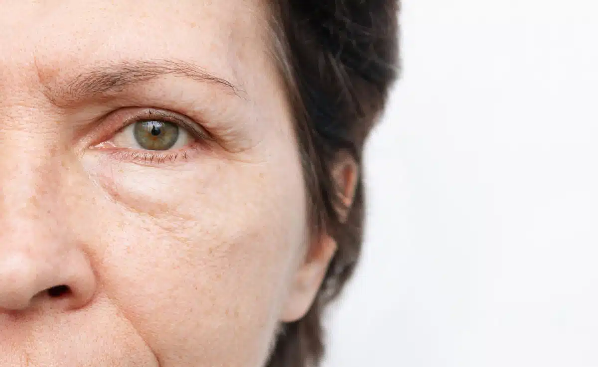 
Eye Puffiness: Swelling in the eyes, know its cause and remedies to cure it.