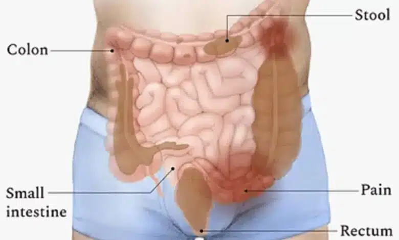 What is Constipation ? Causes and Risk Factors