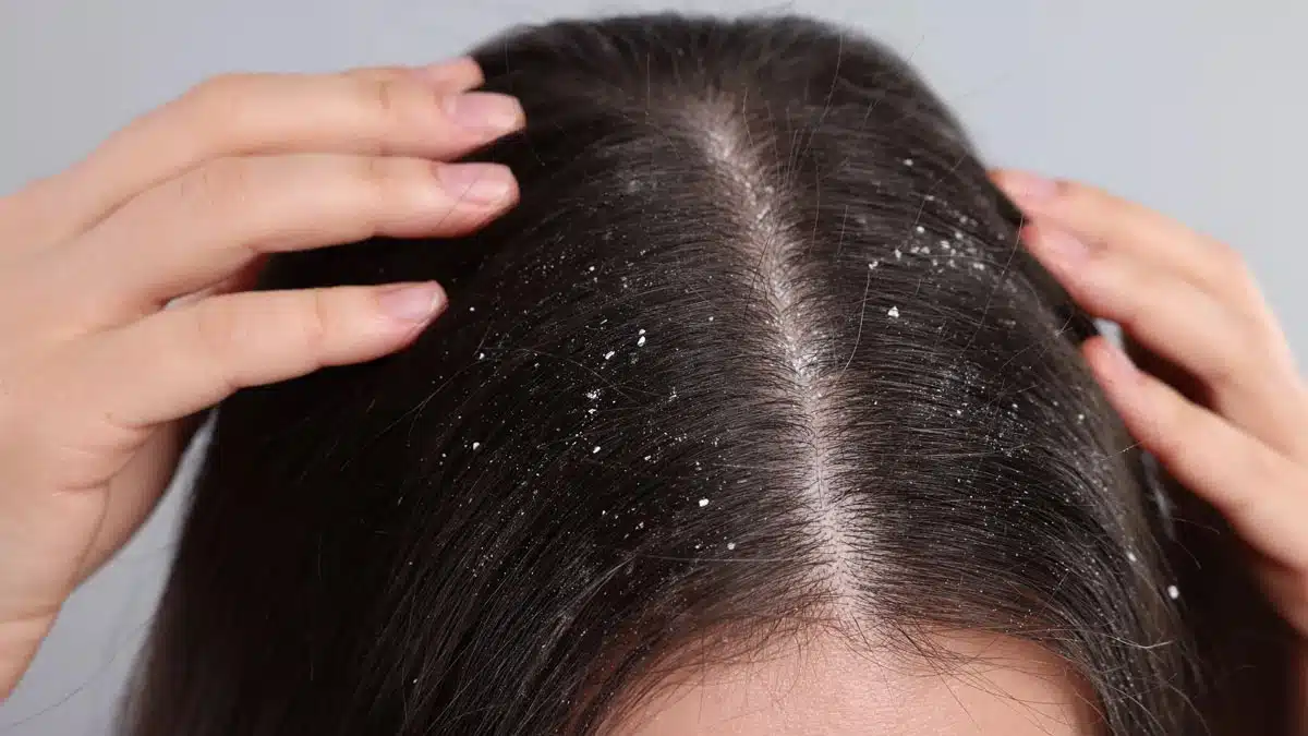 7 common causes of dandruff that you must know