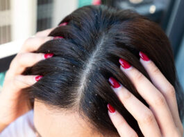 6 home remedies to get relief from dandruff