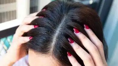 6 home remedies to get relief from dandruff