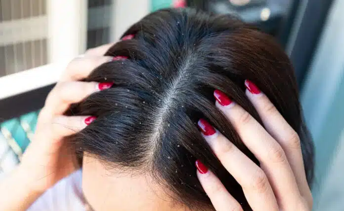 6 home remedies to get relief from dandruff