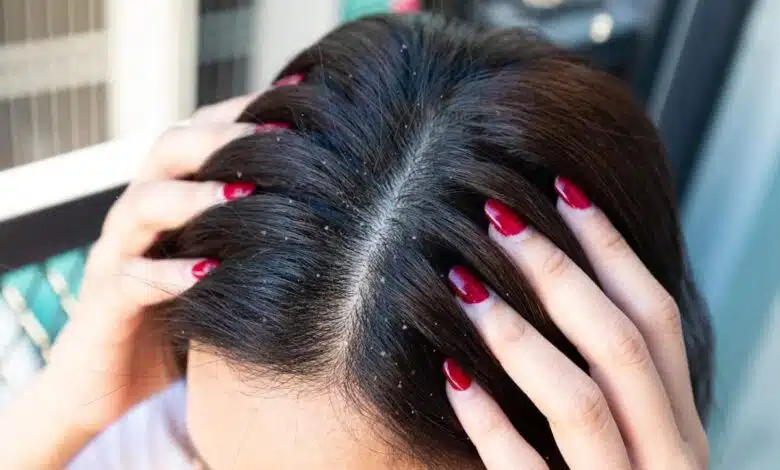 6 home remedies to get relief from dandruff