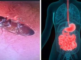 Delhi doctors save man life by removing live cockroach from his intestines