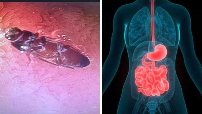 Delhi doctors save man life by removing live cockroach from his intestines