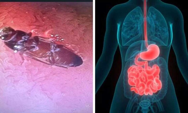 Delhi doctors save man life by removing live cockroach from his intestines