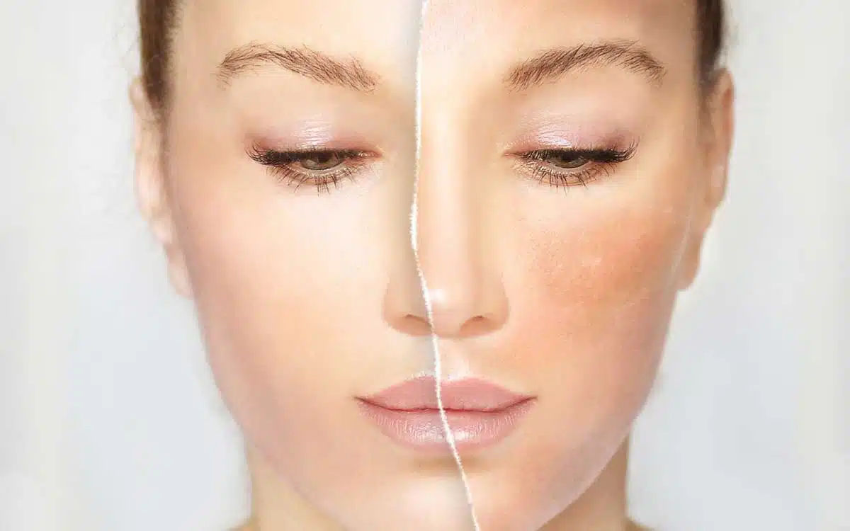 Dull Skin Causes, Effects and Solutions