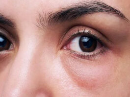 Eye Puffiness: Swelling in the eyes, know its cause and remedies to cure it.