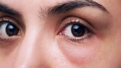 Eye Puffiness: Swelling in the eyes, know its cause and remedies to cure it.