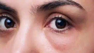 Eye Puffiness: Swelling in the eyes, know its cause and remedies to cure it.