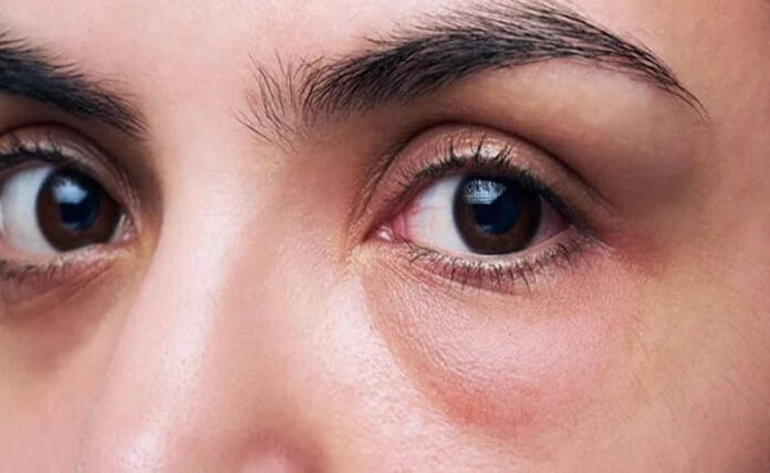 Eye Puffiness: Swelling in the eyes, know its cause and remedies to cure it.