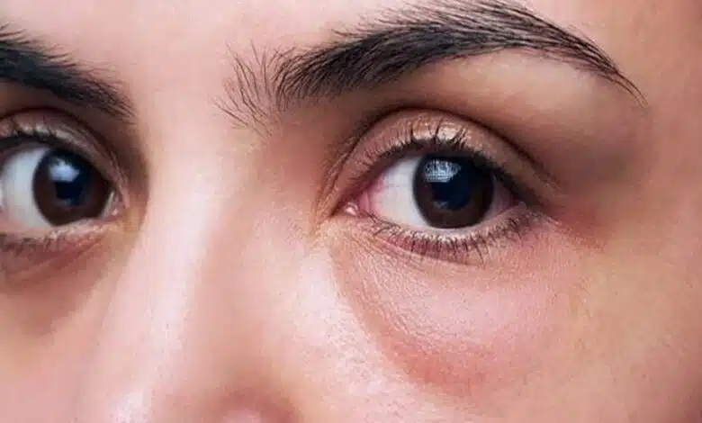 Eye Puffiness: Swelling in the eyes, know its cause and remedies to cure it.