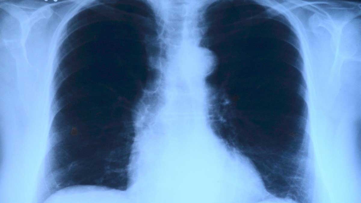 India develops indigenous handheld X-ray device for TB diagnosis