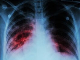 India develops indigenous handheld X-ray device for TB diagnosis