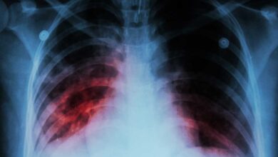 India develops indigenous handheld X-ray device for TB diagnosis