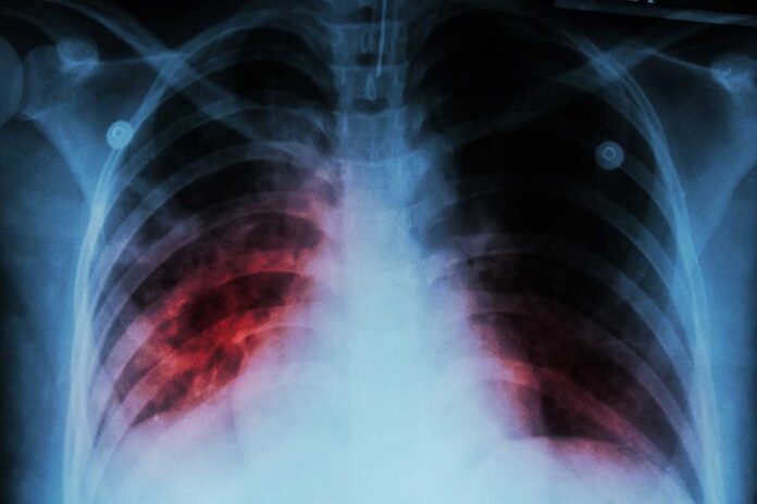 India develops indigenous handheld X-ray device for TB diagnosis