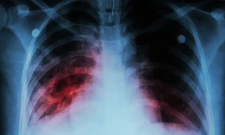 India develops indigenous handheld X-ray device for TB diagnosis