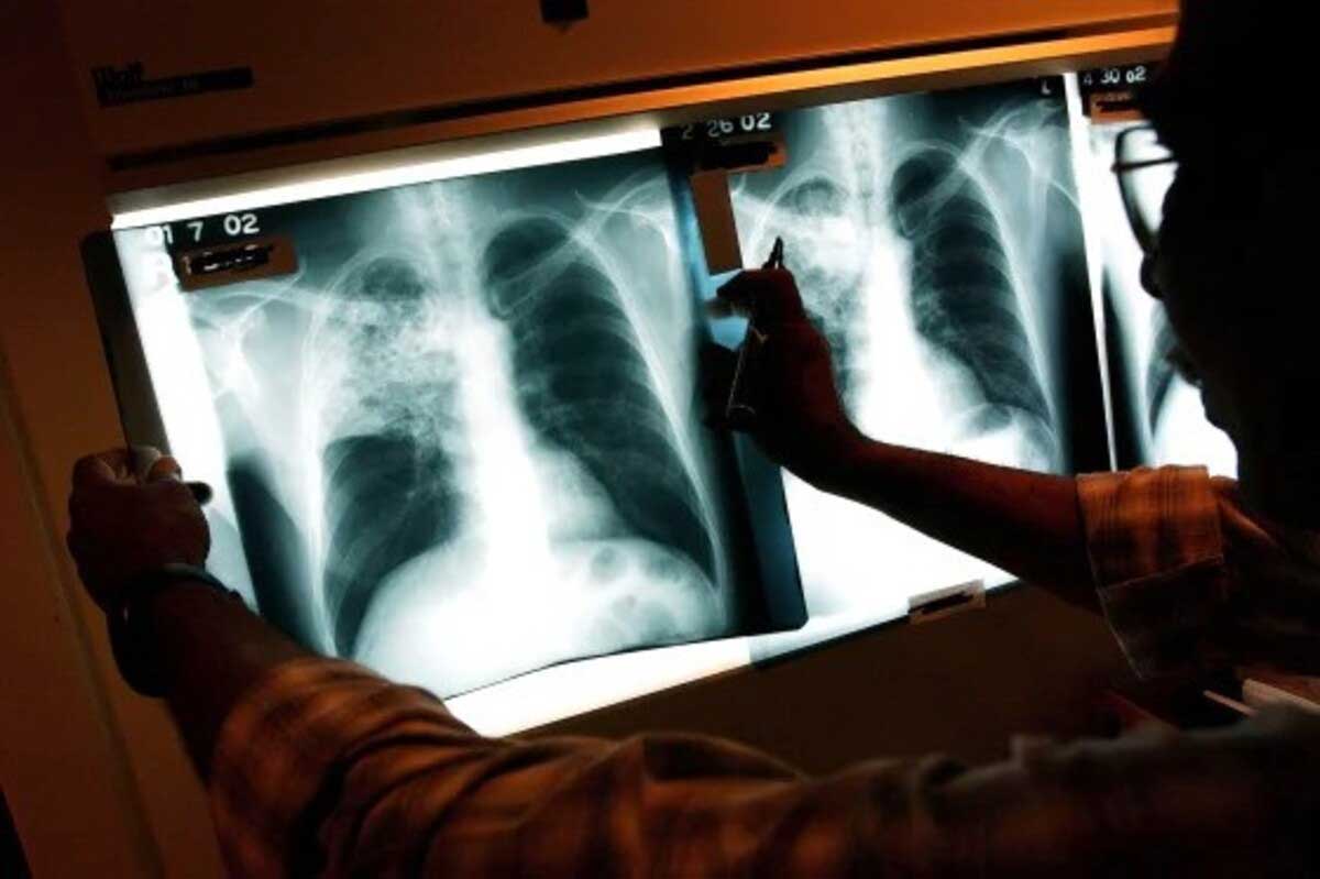 India develops indigenous handheld X-ray device for TB diagnosis