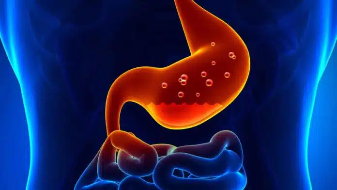 What is indigestion? Symptoms and treatment