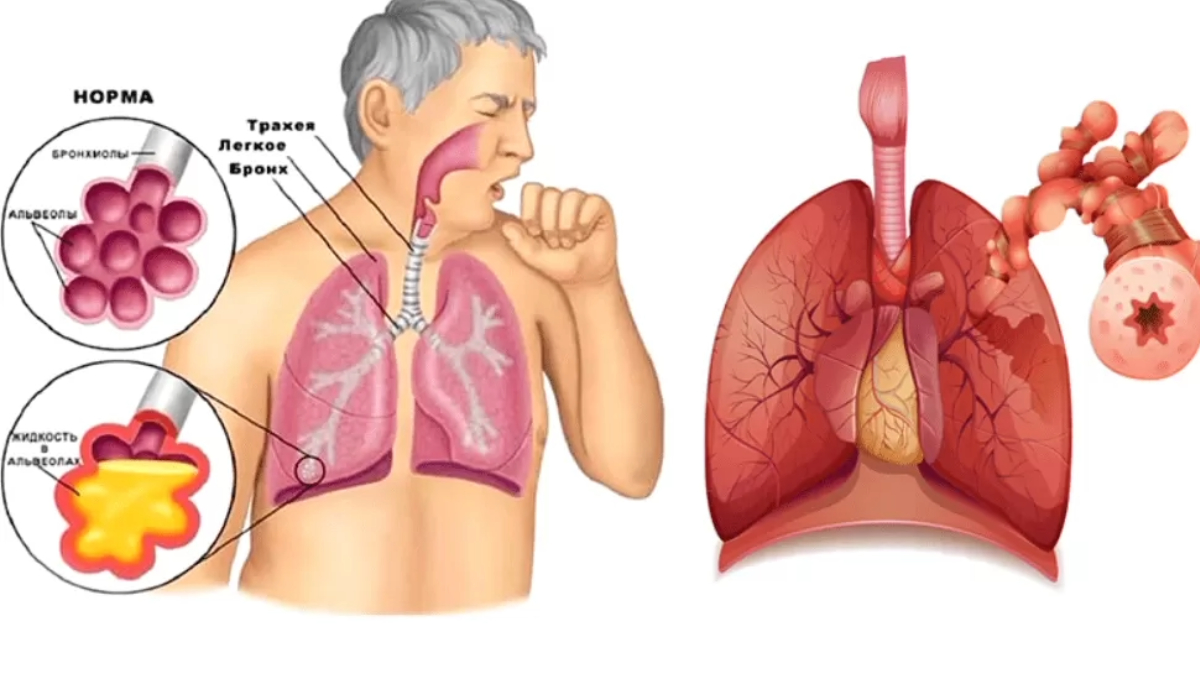 Causes of cough and its symptoms