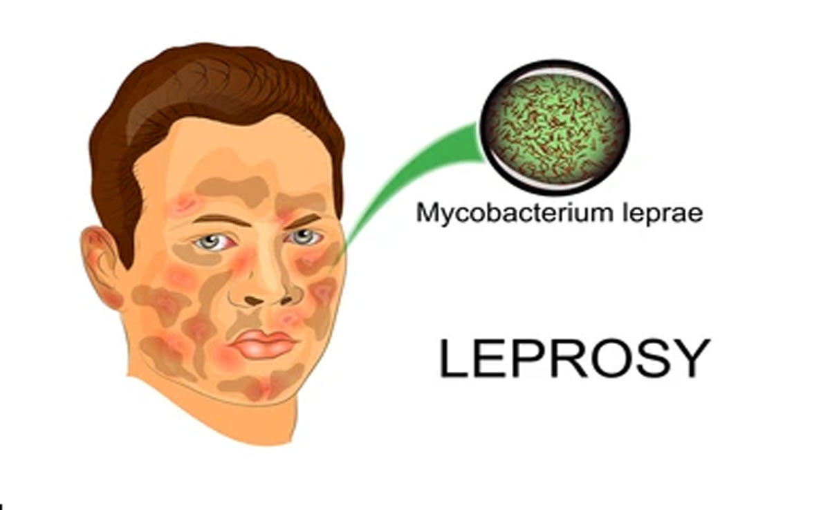 How Can They Raise Awareness About Leprosy?