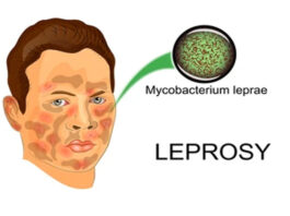 What Causes Leprosy and How Is It Transmitted?