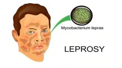 What Causes Leprosy and How Is It Transmitted?