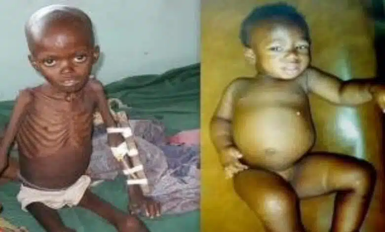 What is marasmus? Definition and prevalence