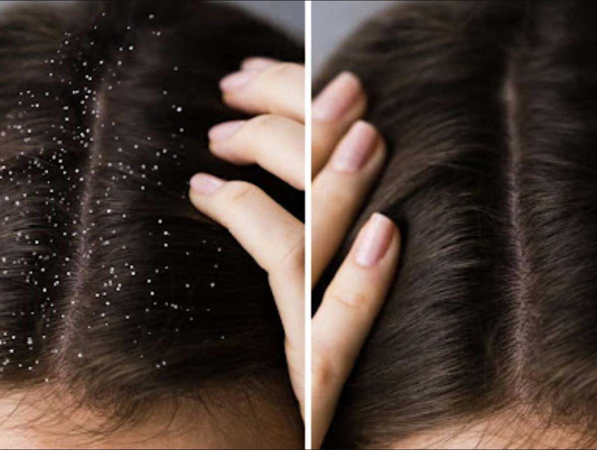 Neem Natural Solution for Hair Care