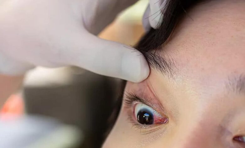 What is Ophthalmia neonatorum?