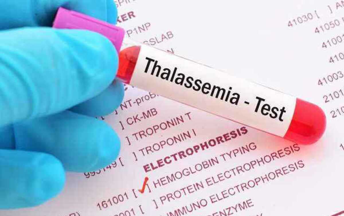 Thalassemia minor meaning, symptoms and treatment