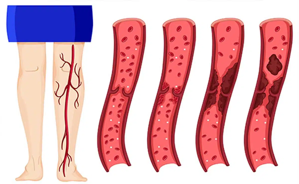 Thrombosis: A Comprehensive Overview