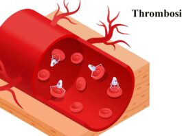 Thrombosis: A Comprehensive Overview