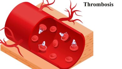 Thrombosis: A Comprehensive Overview