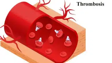 Thrombosis: A Comprehensive Overview