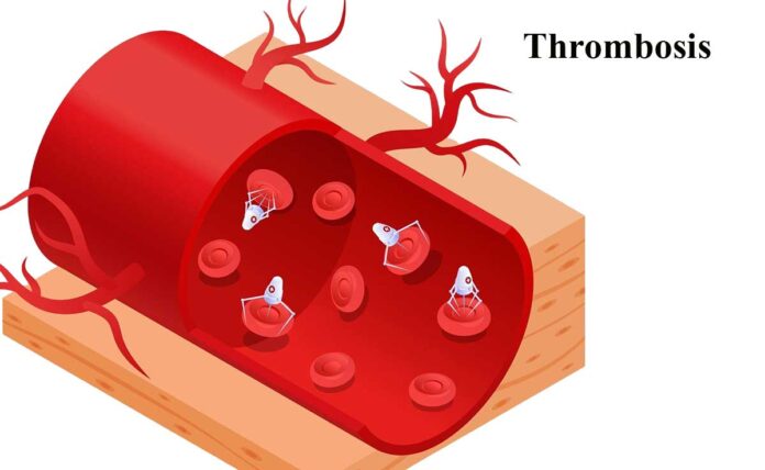 Thrombosis: A Comprehensive Overview